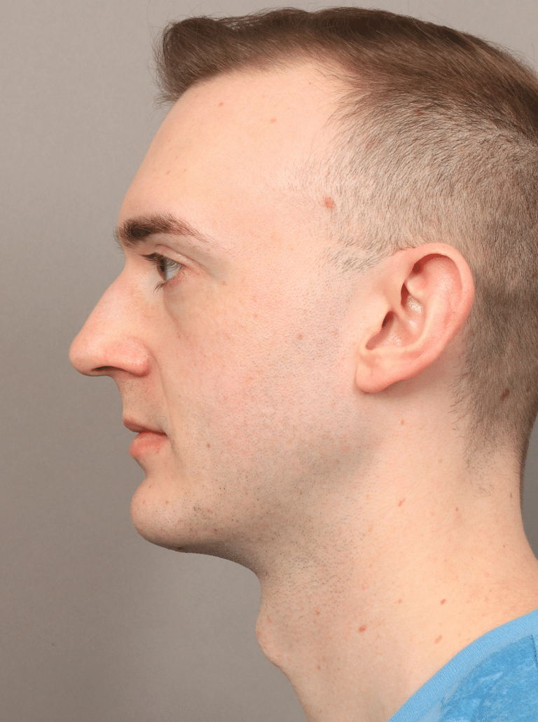 After Image: Chin & Jaw Implants (7 Months Post-op) - left-side