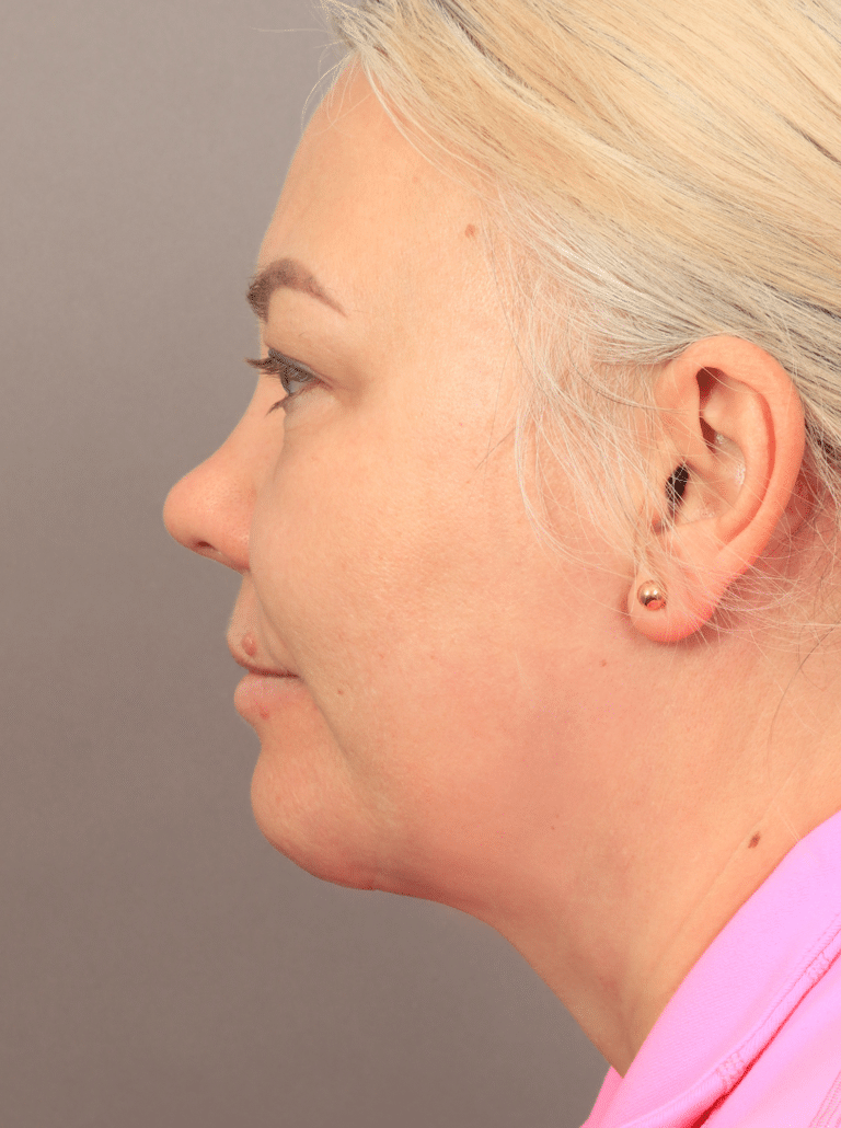 After Image: Neck Lift with Platysmaplasty, Upper Eyelid Lift, Brow Lift, and CO2 Resurfacing (2 Months post-op) - left-side