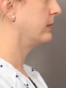 After Image: Liposuction, Renuvion, and Facial Implants (4.5 Months Post-op)