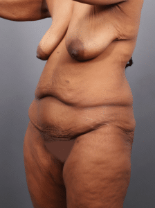 Before Image: Post Weight Loss: Lower Body Lift, Liposuction & Renuvion Skin Tightening (3 Months Post-op)