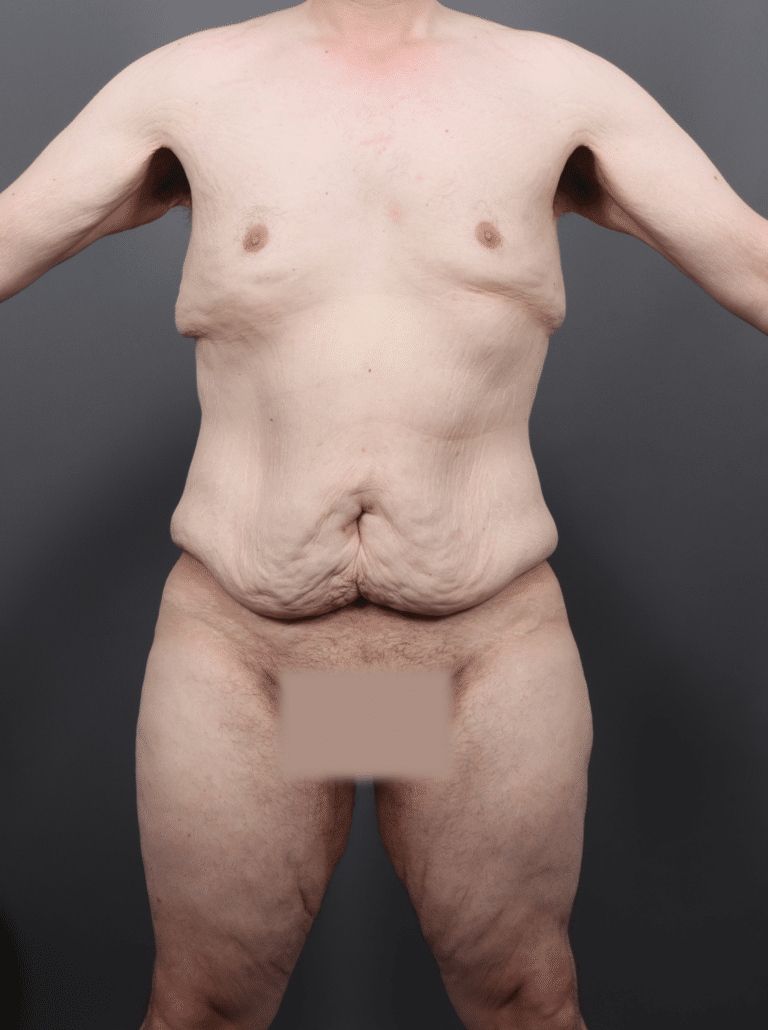 Before Image: Post Weight Loss: Lower Body Lift, Liposuction & Renuvion Skin Tightening (1 Month Post-op) - front