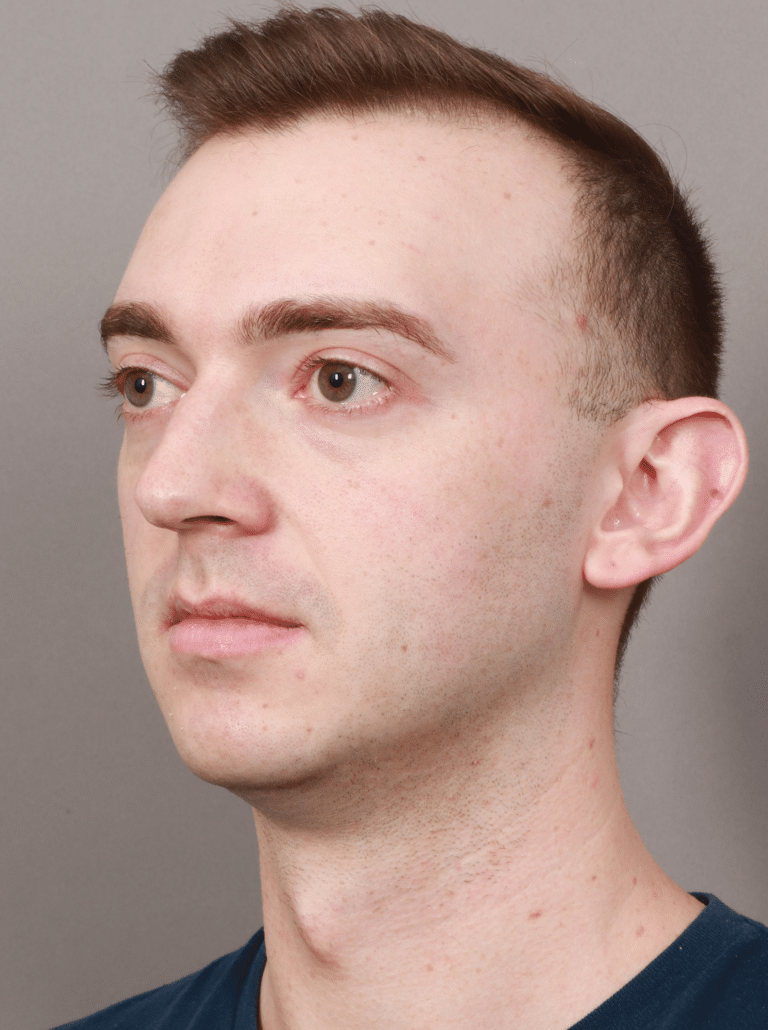Before Image: Chin & Jaw Implants (7 Months Post-op) - left-front-oblique