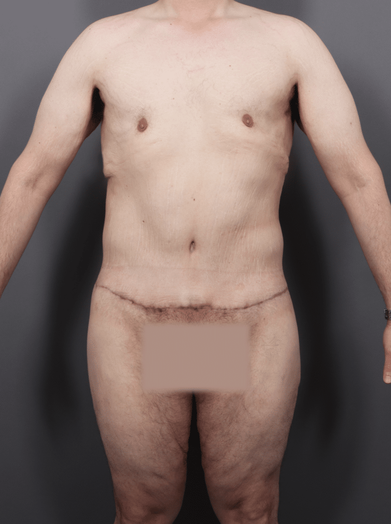 After Image: Post Weight Loss: Lower Body Lift, Liposuction & Renuvion Skin Tightening (1 Month Post-op) - front