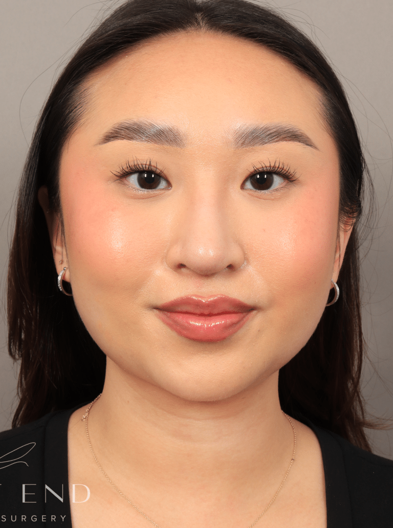 After Image: Submental Liposuction, Renuvion, and Rhinoplasty (3 Months Post-op) - front