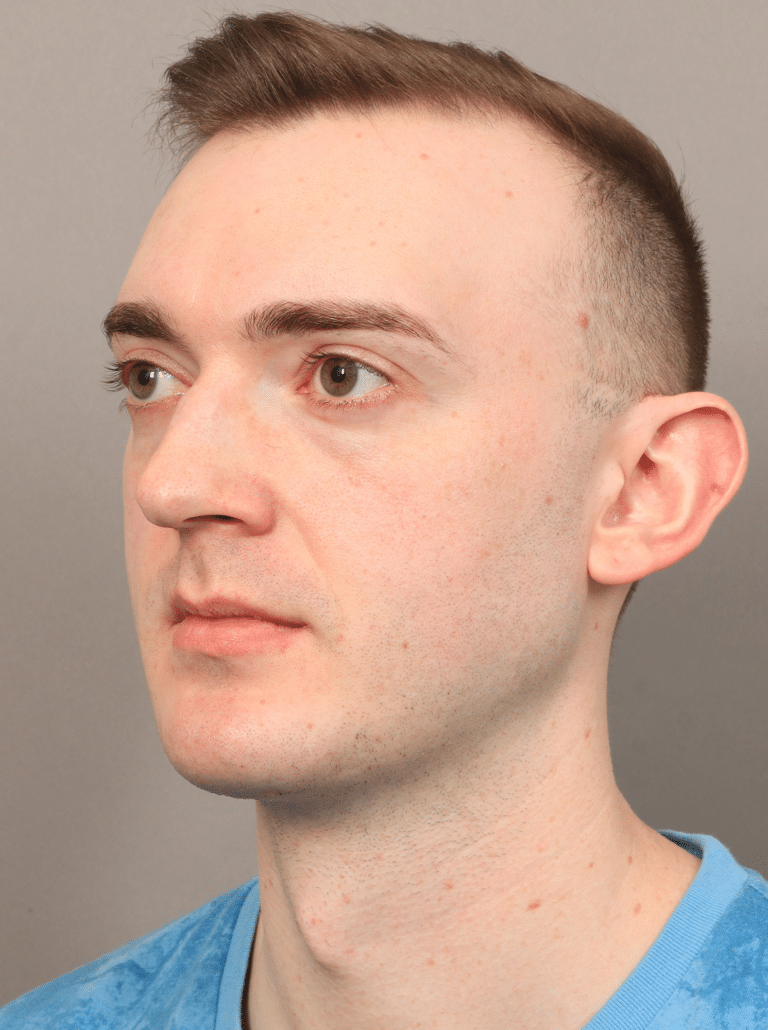 After Image: Chin & Jaw Implants (7 Months Post-op) - left-front-oblique
