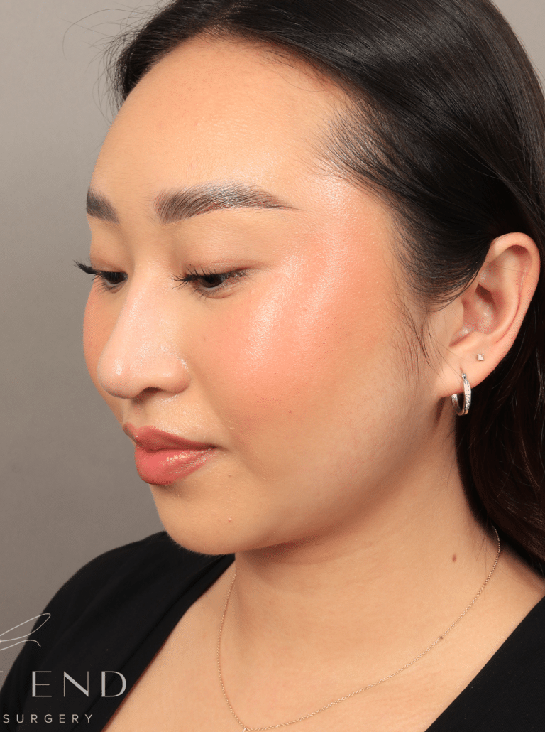 After Image: Submental Liposuction, Renuvion, and Rhinoplasty (3 Months Post-op) - left-front-oblique