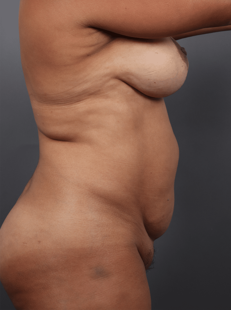 Before Image: Tummy Tuck with Liposuction (1 Year Post-op) - right-side