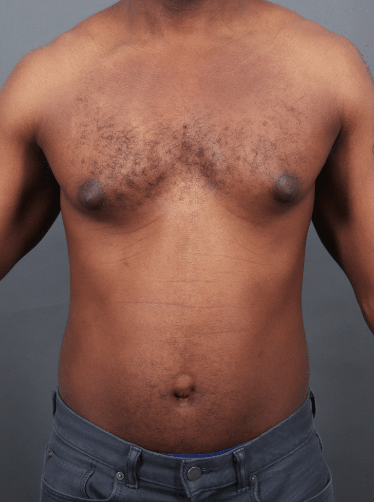 Before Image: Gynecomastia (using Liposuction & Renuvion) - front