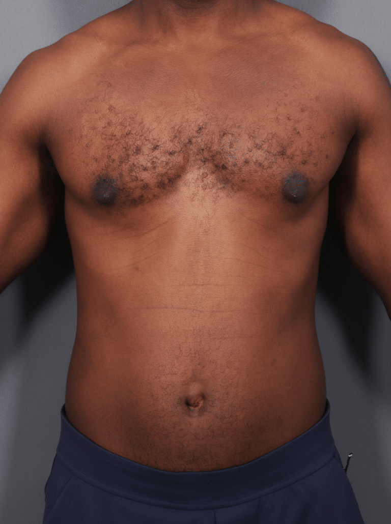 After Image: Gynecomastia (using Liposuction & Renuvion) - front