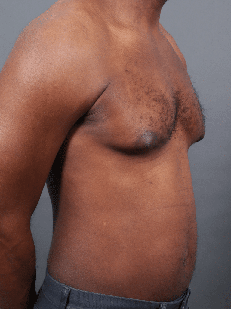 Before Image: Gynecomastia (using Liposuction & Renuvion) - right-front-oblique