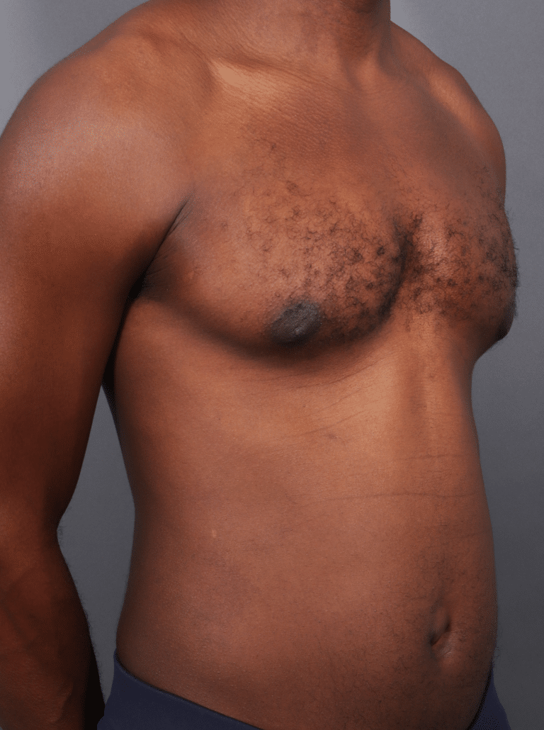 After Image: Gynecomastia (using Liposuction & Renuvion) - right-front-oblique