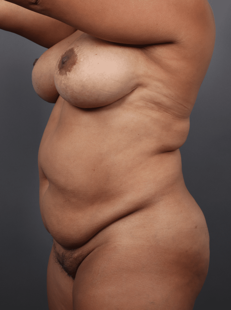 Before Image: Tummy Tuck with Liposuction (1 Year Post-op) -