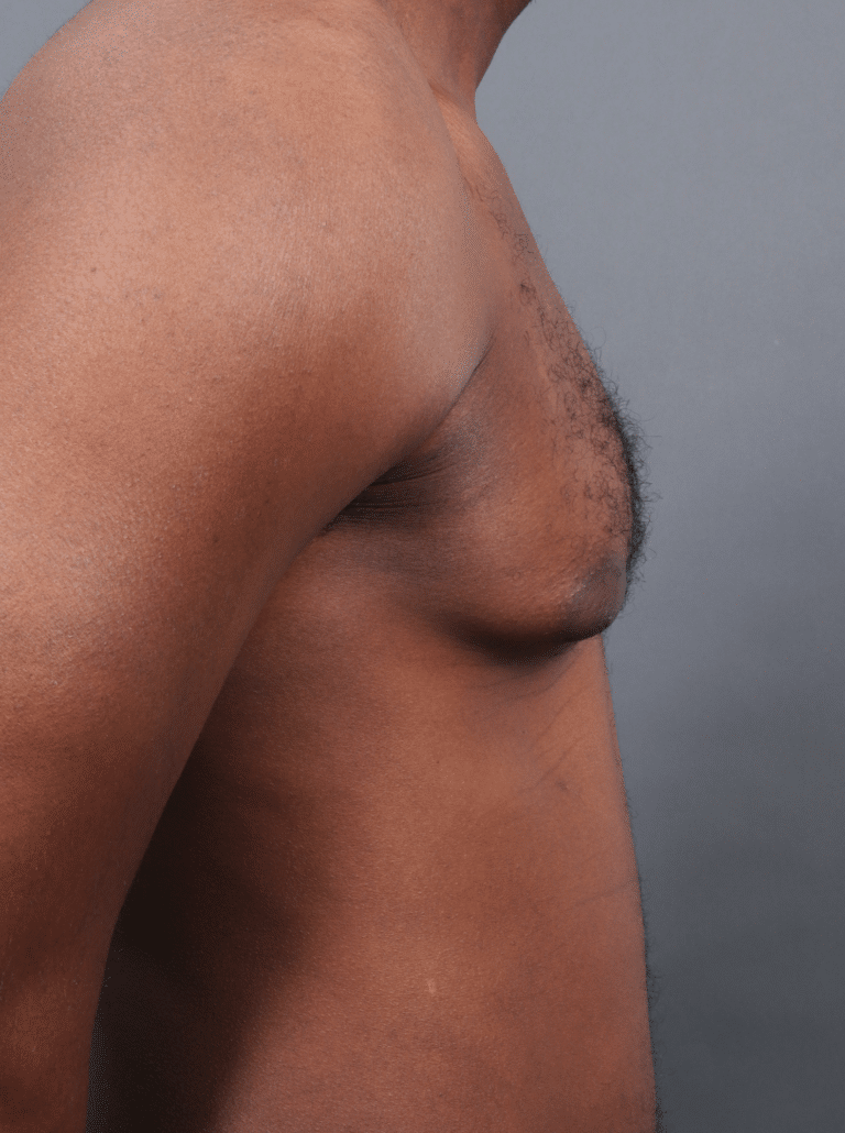 Before Image: Gynecomastia (using Liposuction & Renuvion) - right-side