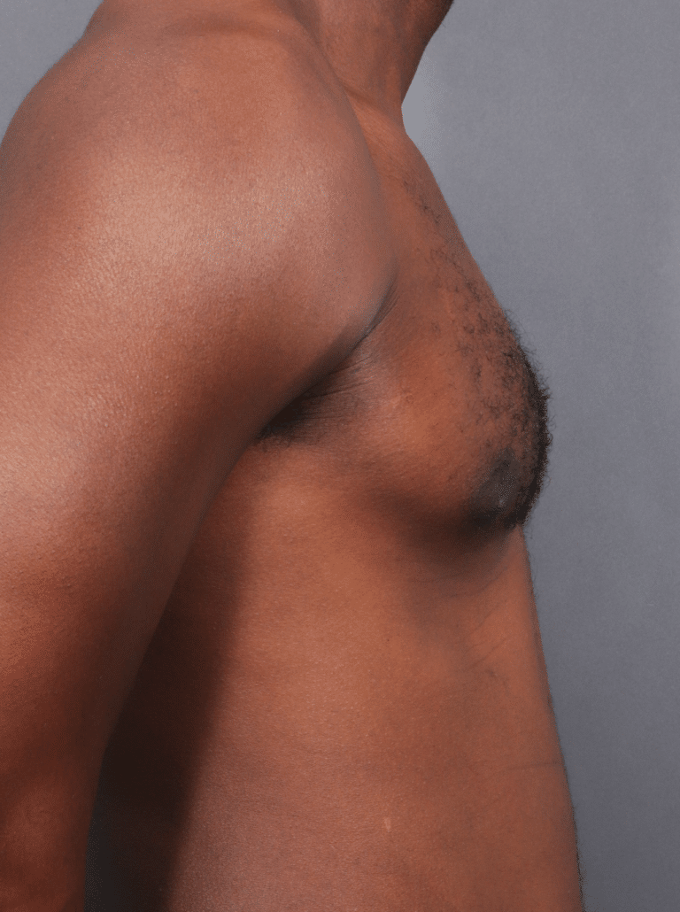 After Image: Gynecomastia (using Liposuction & Renuvion) - right-side