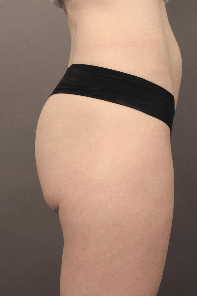 Before Image: Non-Surgical Butt Lift (BBL) - right-side