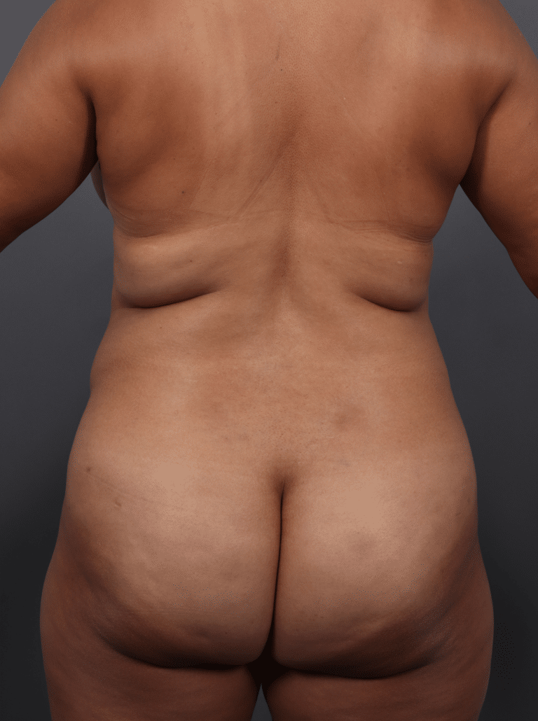 Before Image: Tummy Tuck with Liposuction (1 Year Post-op) - back