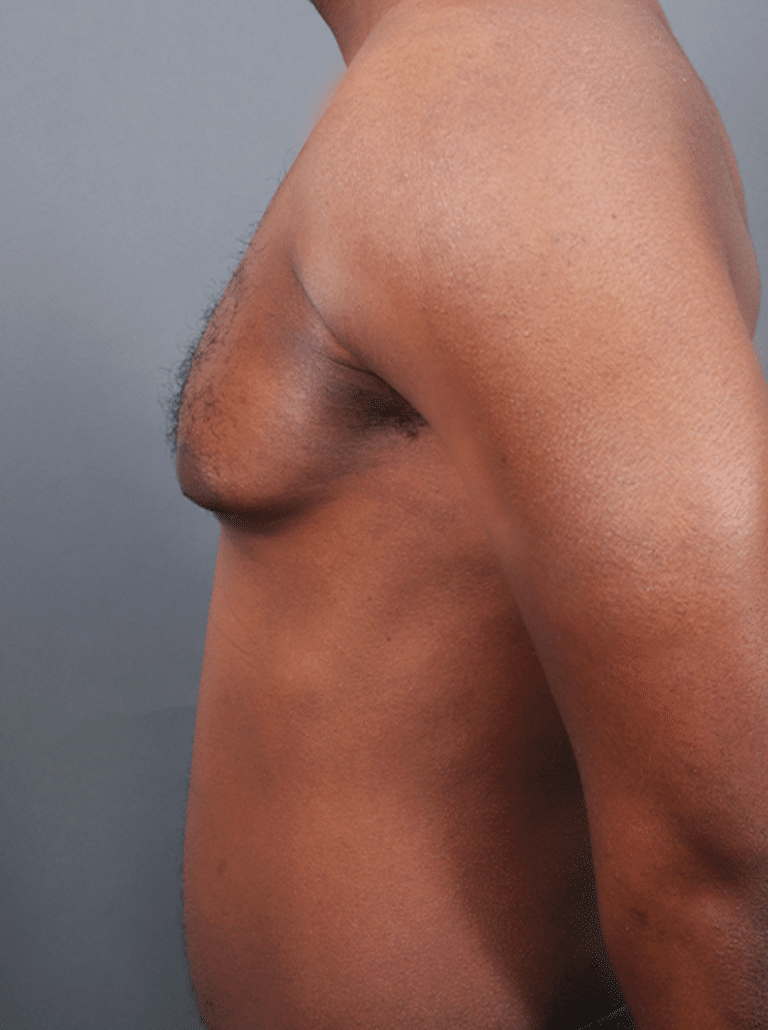 Before Image: Gynecomastia (using Liposuction & Renuvion) - left-side