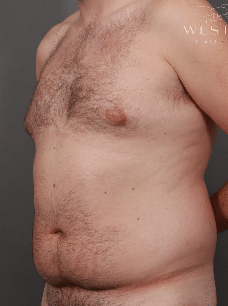 Before Image: Liposuction and Renuvion Skin Tightening (5 Months Post-Op) - left-front-oblique