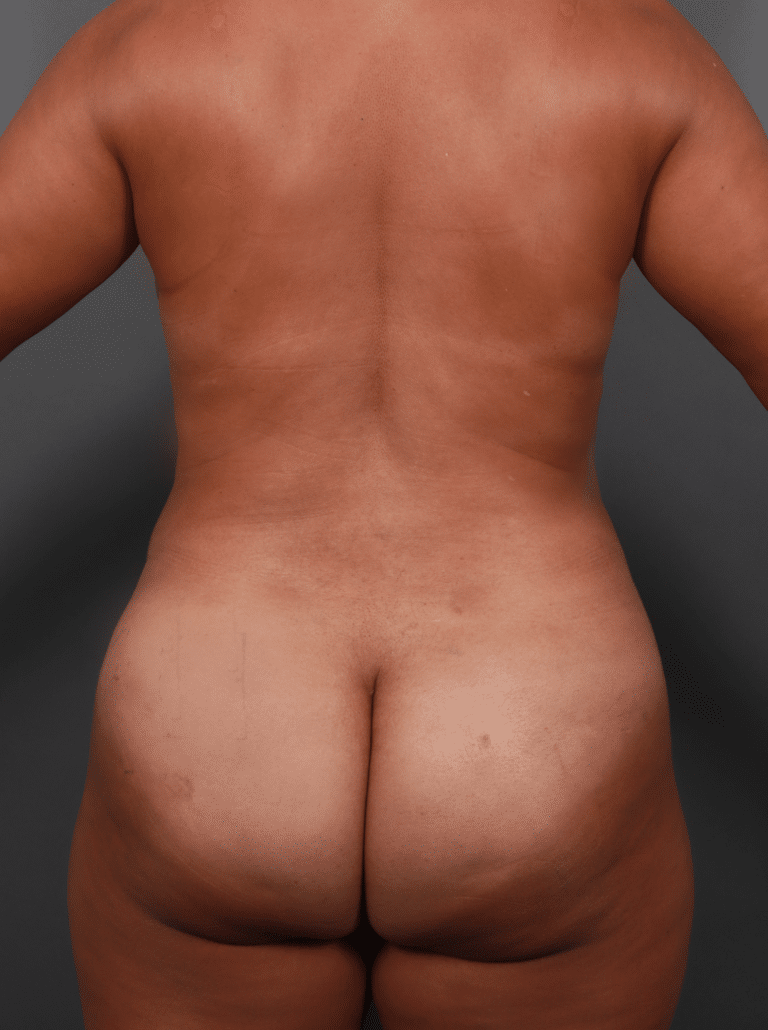 After Image: Tummy Tuck with Liposuction (1 Year Post-op) - back