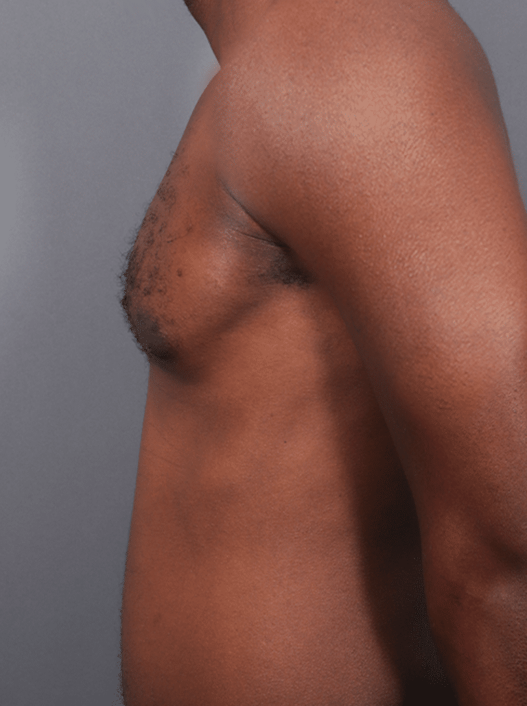 After Image: Gynecomastia (using Liposuction & Renuvion) - left-side