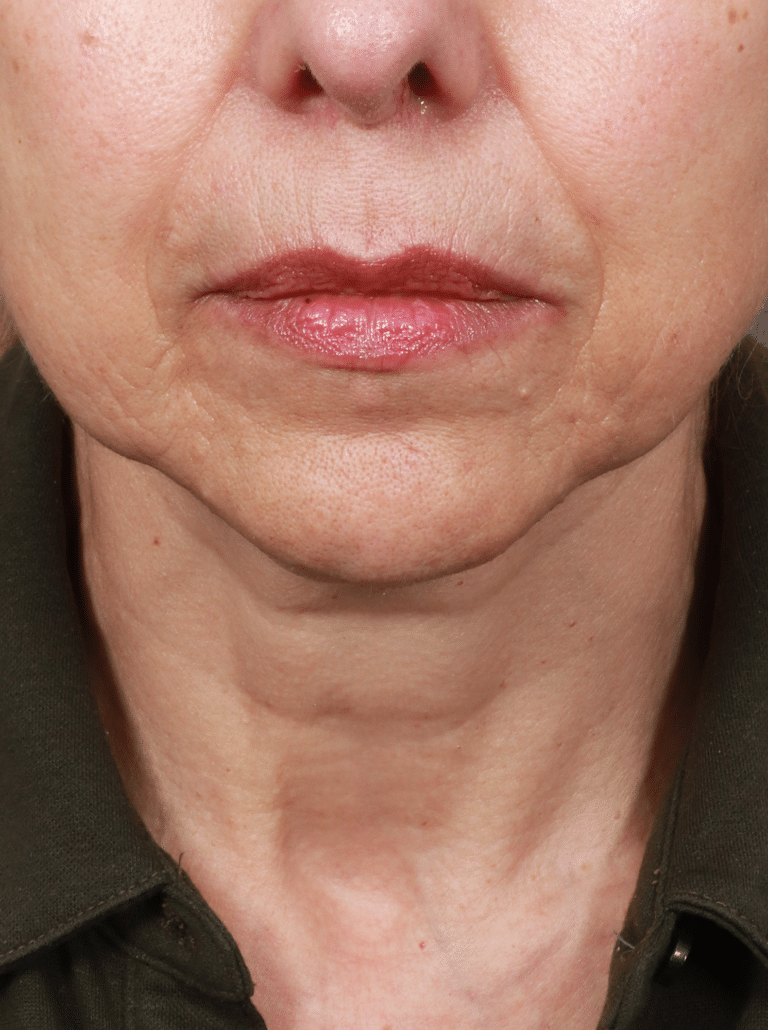 Before Image: Lip Lift (1 Year Post-op) - front