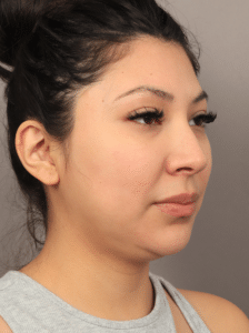 Before Image: Liposuction & Renuvion Skin Tightening (2.5 Months Post-op)