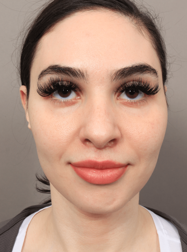 Before Image: Rhinoplasty & Facial Fat Grafting (5.5 Months Post-op) - front