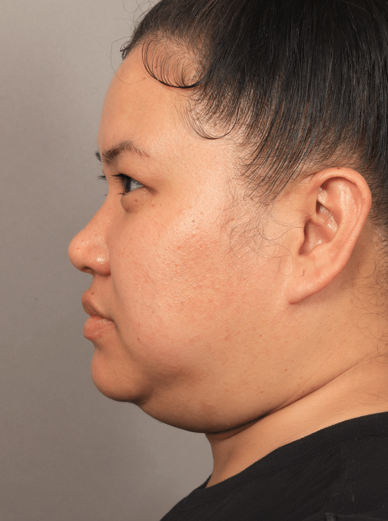 Before Image: Liposuction & Renuvion Skin Tightening (1.5 Months post-op) - left-side
