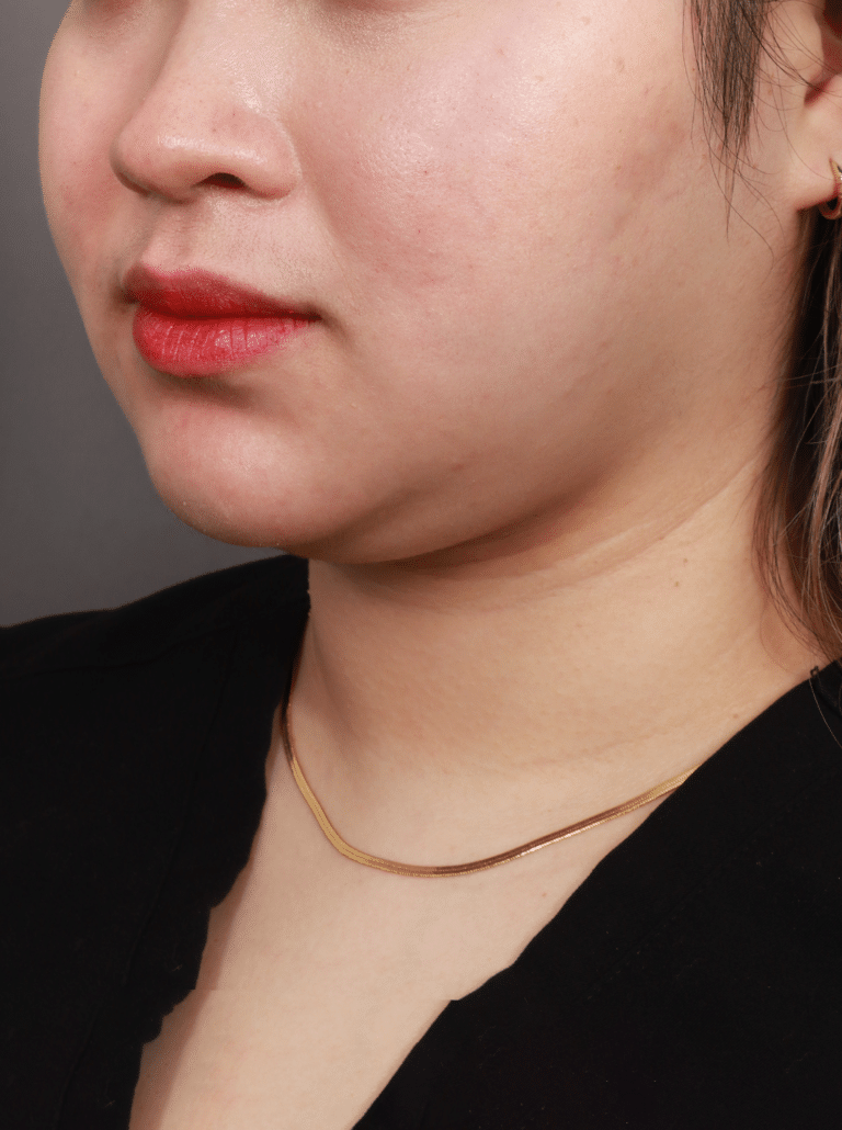 Before Image: Liposuction of the Submental, Jawline, and Neck Region (3 Months Post-Op) - left-front-oblique