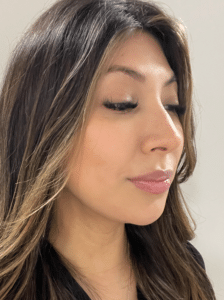 After Image: Liposuction & Renuvion Skin Tightening (2.5 Months Post-op)