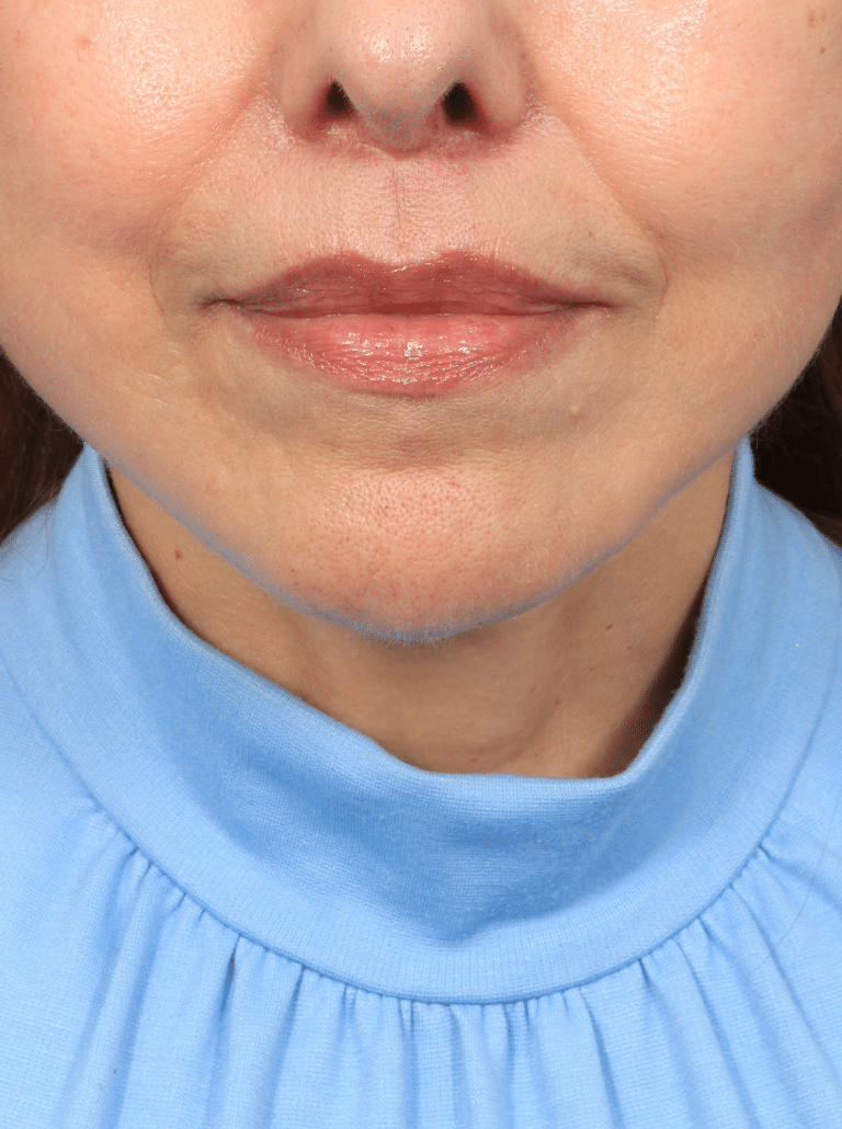 After Image: Lip Lift (1 Year Post-op) - front