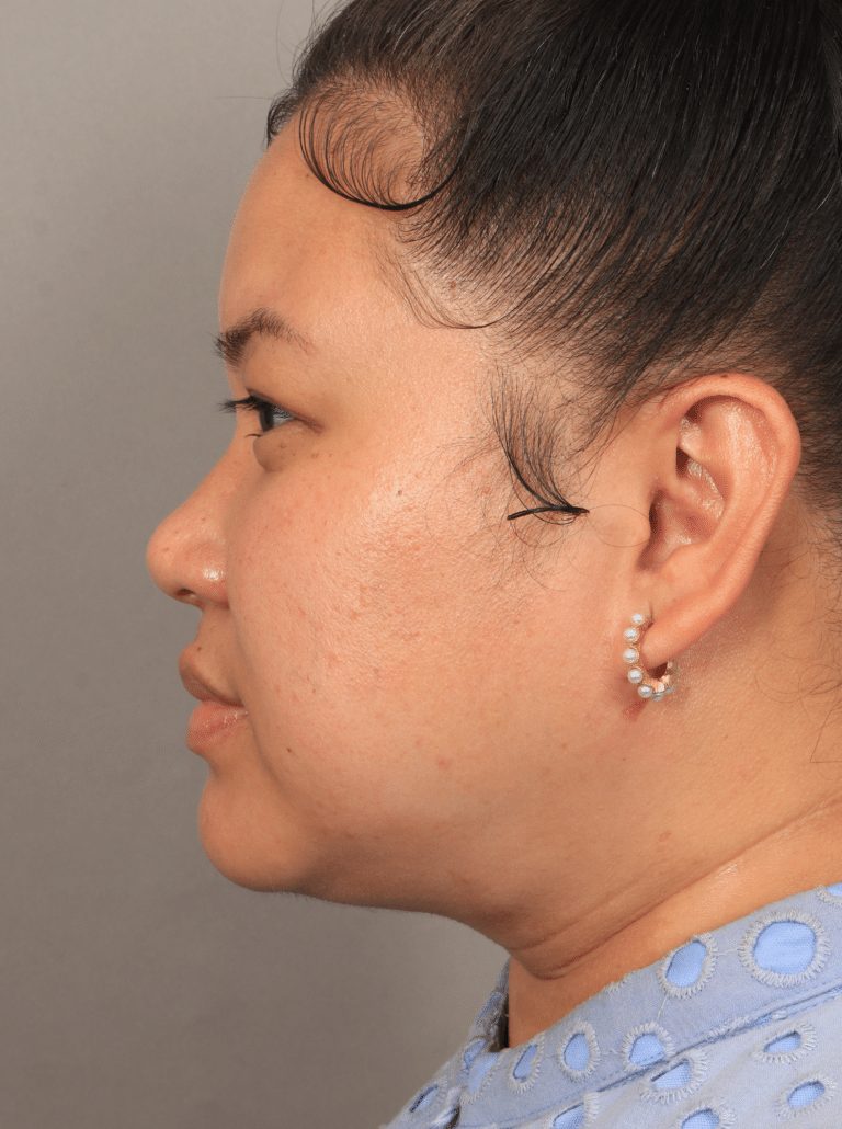 After Image: Liposuction & Renuvion Skin Tightening (1.5 Months post-op) - left-side
