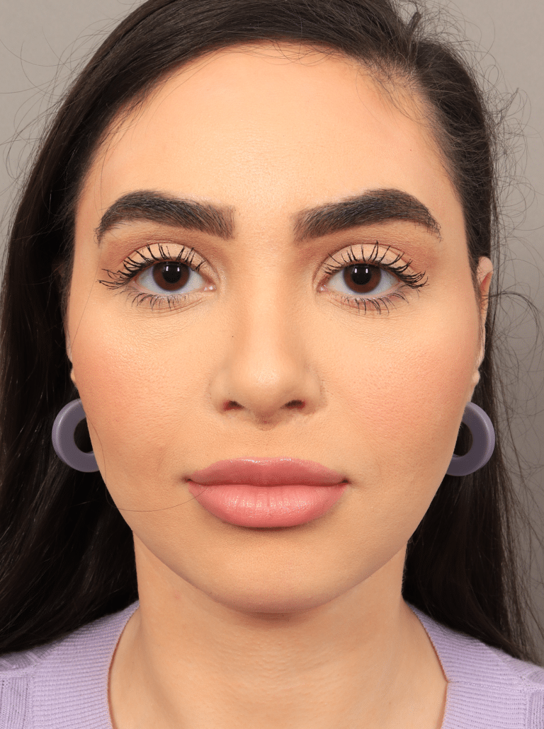After Image: Rhinoplasty & Facial Fat Grafting (5.5 Months Post-op) - front