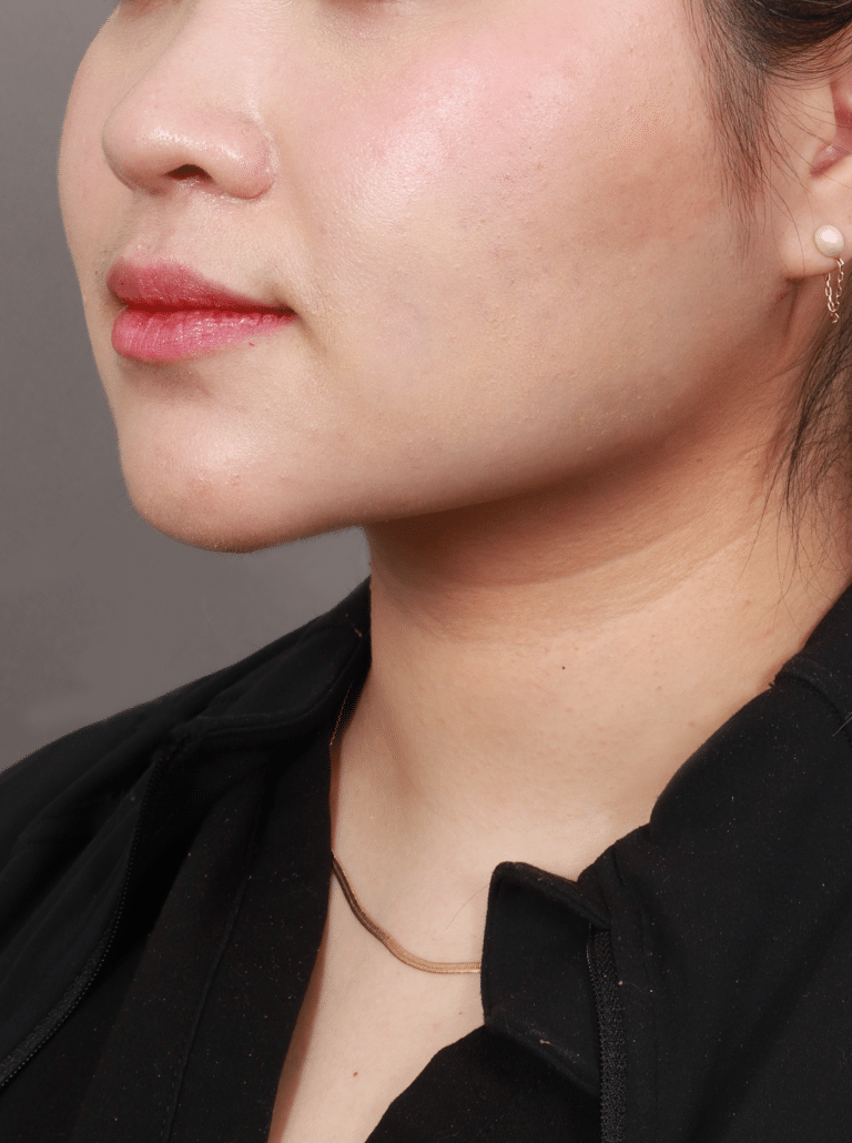 After Image: Liposuction of the Submental, Jawline, and Neck Region (3 Months Post-Op) - left-front-oblique
