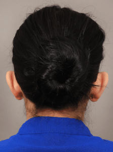 Before Image: Otoplasty (1 Month Post-op)