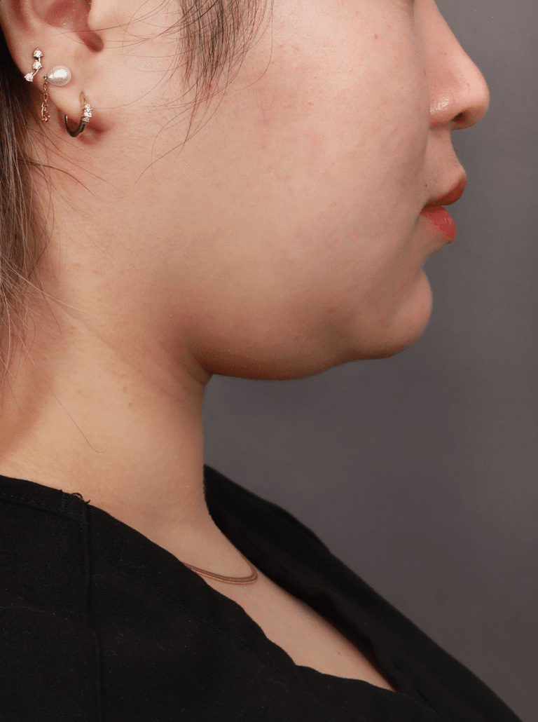 Before Image: Liposuction of the Submental, Jawline, and Neck Region (3 Months Post-Op) - right-side