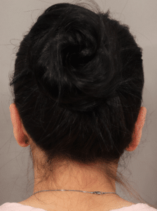 After Image: Otoplasty (1 Month Post-op)