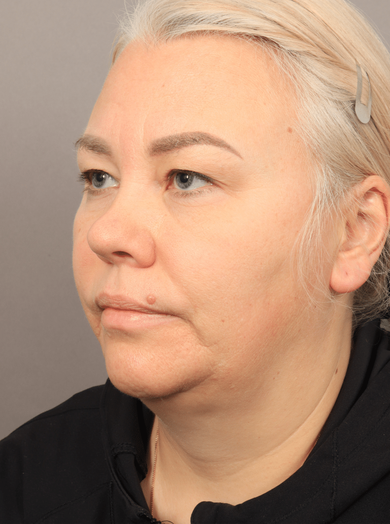 Before Image: Neck Lift with Platysmaplasty, Upper Eyelid Lift, Brow Lift, and CO2 Resurfacing (4 Months Post-op) - left-front-oblique
