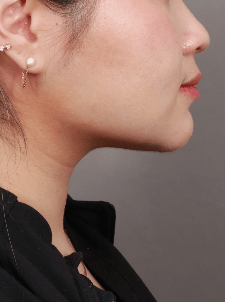 After Image: Liposuction of the Submental, Jawline, and Neck Region (3 Months Post-Op) - right-side