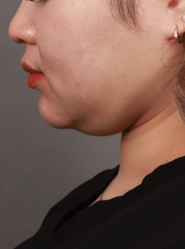 Before Image: Liposuction of the Submental, Jawline, and Neck Region (3 Months Post-Op) - left-side
