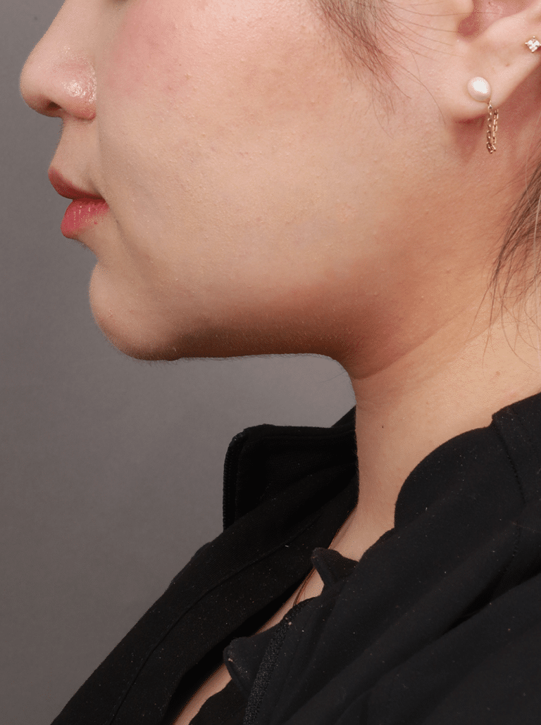 After Image: Liposuction of the Submental, Jawline, and Neck Region (3 Months Post-Op) - left-side