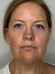 Before Image: Filler