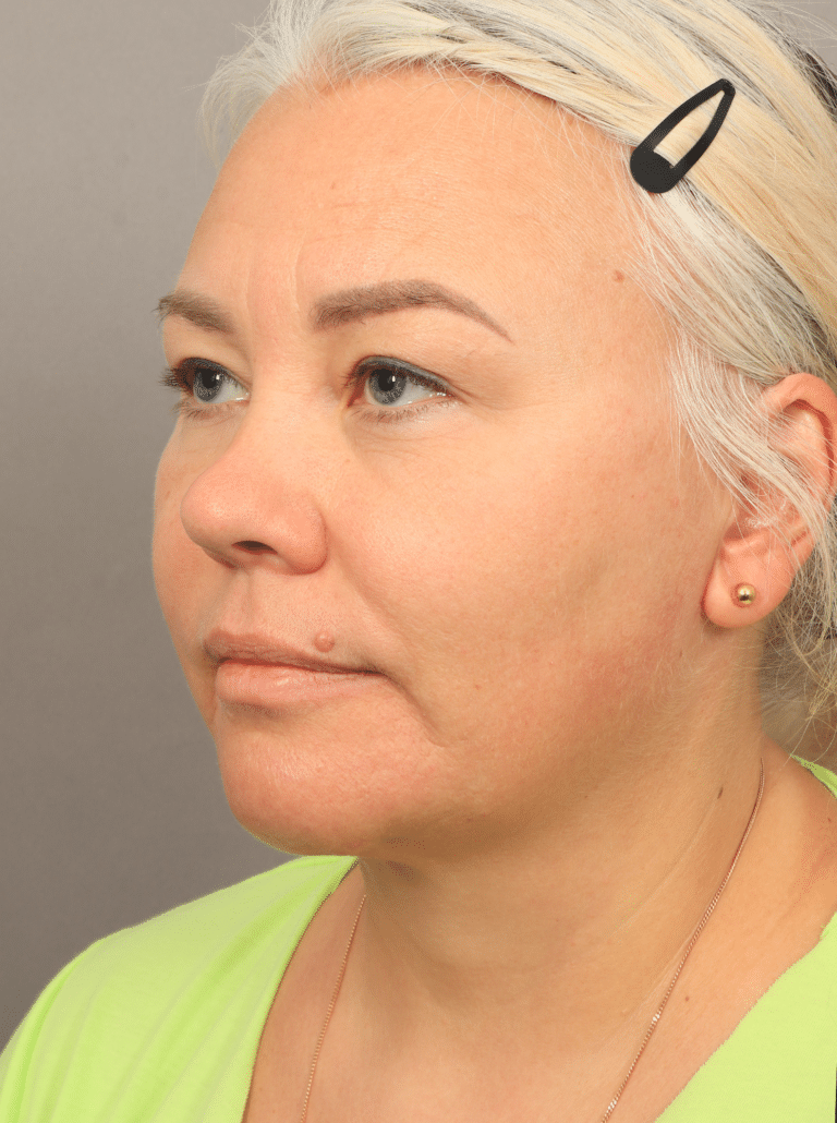 After Image: Neck Lift with Platysmaplasty, Upper Eyelid Lift, Brow Lift, and CO2 Resurfacing (4 Months Post-op) - left-front-oblique