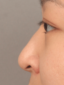 Non-Surgical Rhinoplasty (with Filler)