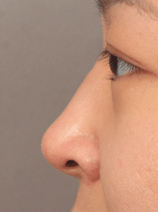 Non-Surgical Rhinoplasty (with Filler)