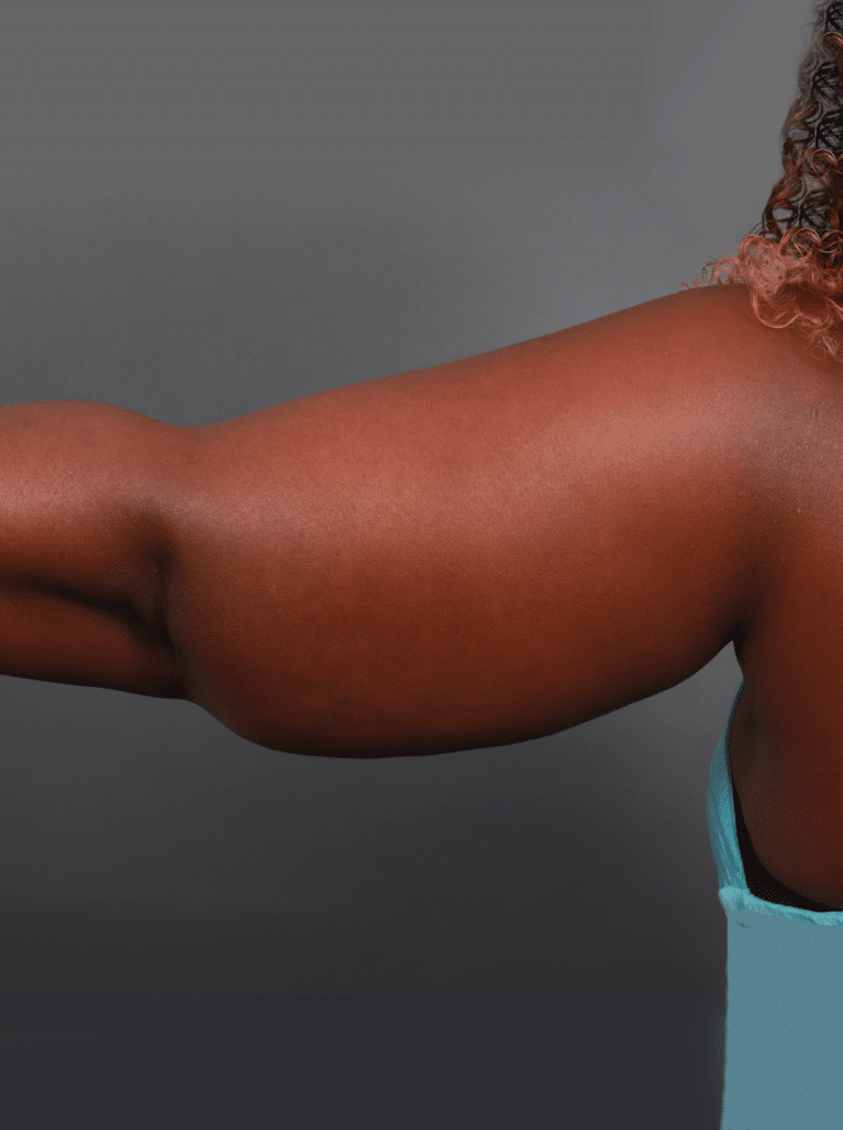 Before Image: Liposuction and Renuvion Skin Tightening (11 Months Post-op) - left-side