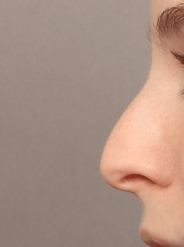 Before Image: Rhinoplasty & Septoplasty (1 Month Post-op) - left-side