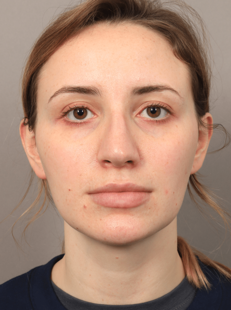 Before Image: Rhinoplasty (5.5 Months Post-op) -