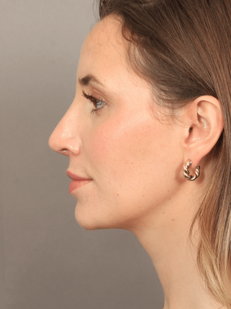 After Image: Rhinoplasty (5.5 Months Post-op) - left-side