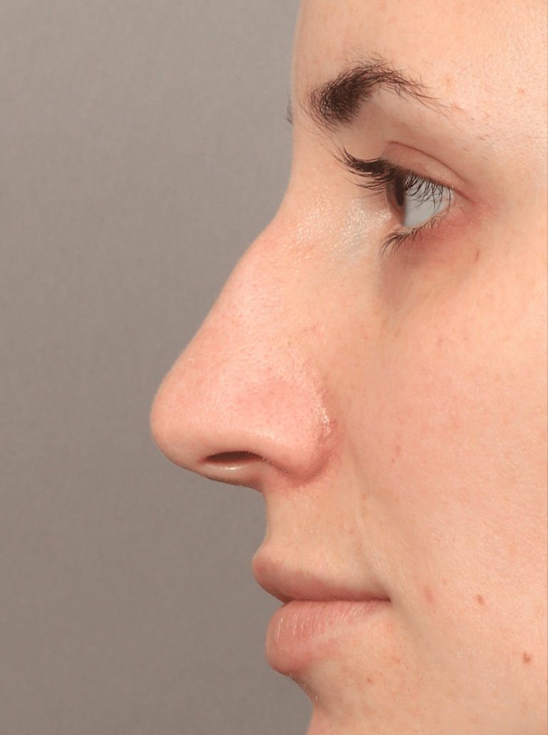Before Image: Rhinoplasty (5.5 Months Post-op) - left-side